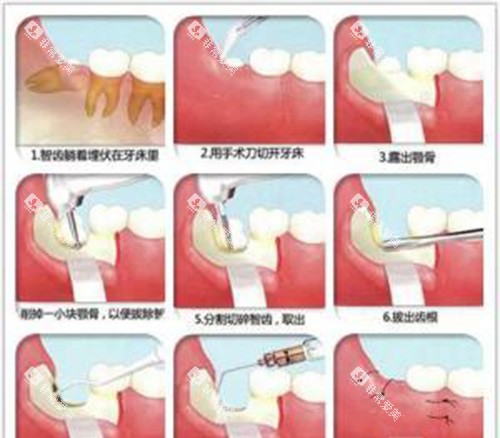 拔智齿过程示意图