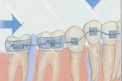 金属矫治器示意图
