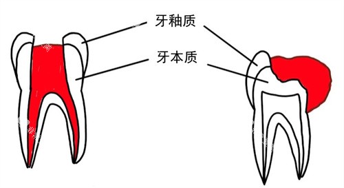 牙齿内息肉外溢