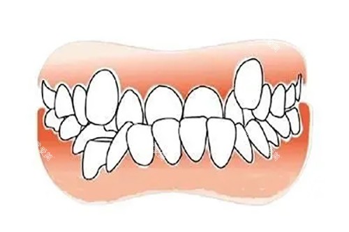 双排多生齿卡通示意图