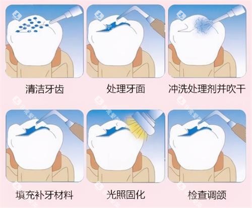 补牙的过程 补牙的过程