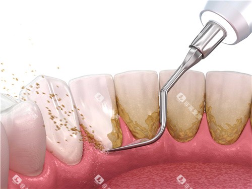 清理牙结石 清理牙结石