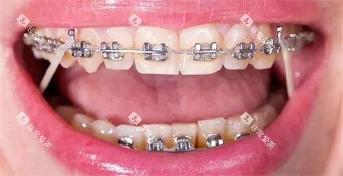 矫正细节图 矫正细节图