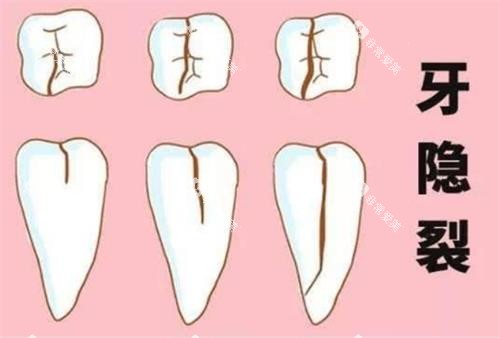 牙齿裂纹的程度 牙齿裂纹的程度