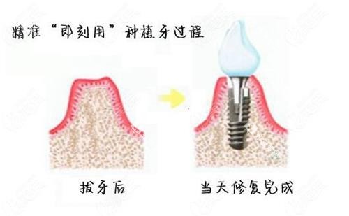 即拔即种