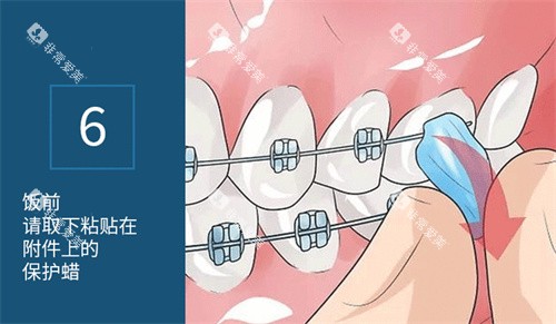 正畸保护蜡使用方法展示图