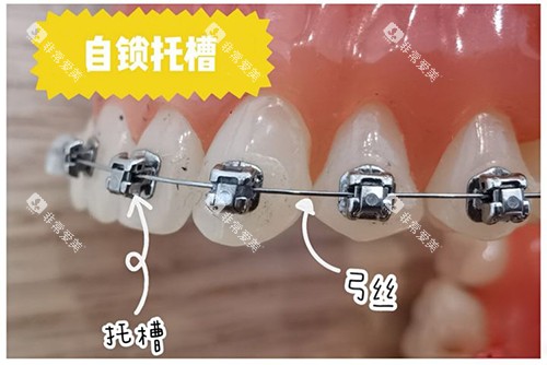 牙齿矫正自锁托槽牙套