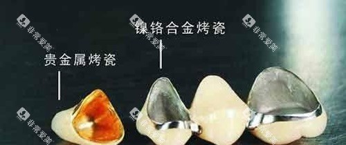 烤瓷牙不同材料示意图