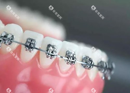 唇侧矫治器示意图