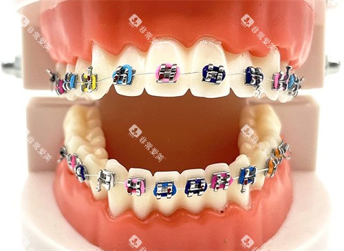 金属托槽矫正模型图片
