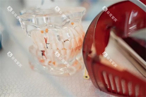 牙齿正畸示意图