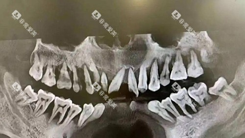 牙槽骨缺失照片图