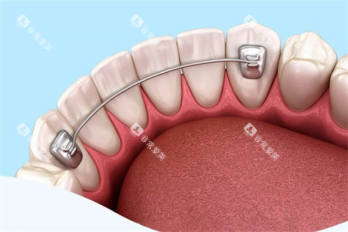 舌侧保持器 舌侧保持器