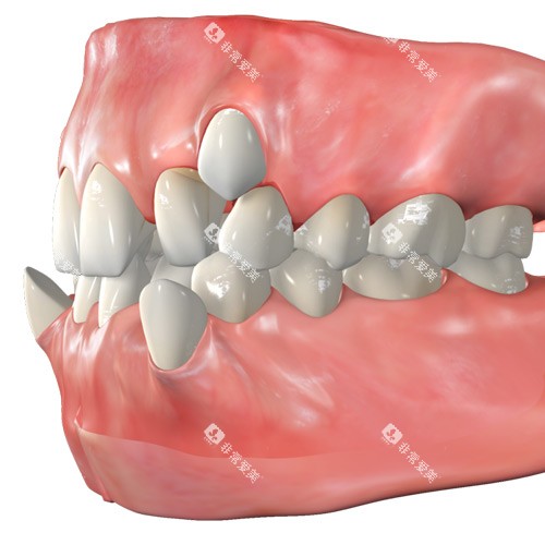 牙齿不整齐 牙齿不整齐