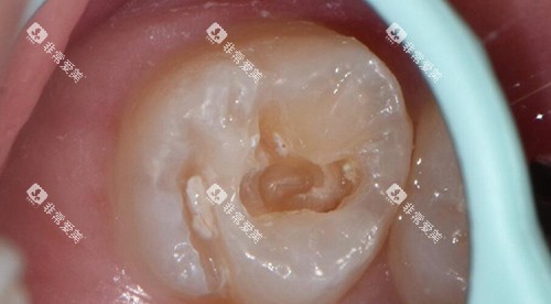 补牙改善图过程 补牙改善图过程