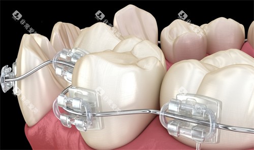 半隐形托槽牙齿矫正细节图 半隐形托槽牙齿矫正细节图