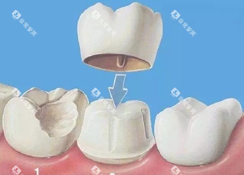 牙冠动画展示图