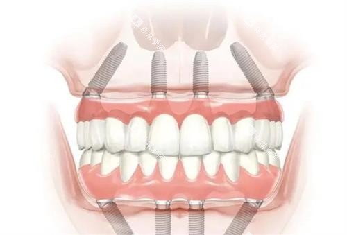 全口种植牙的示意图 全口种植牙的示意图