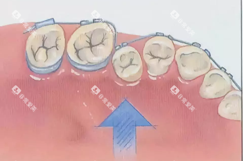 牙齿矫正示意图 牙齿矫正示意图