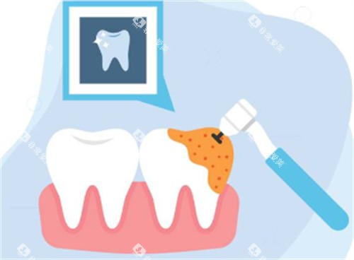 牙钻治疗牙齿图 牙钻治疗牙齿图