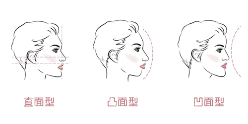 牙齿矫正面型问题