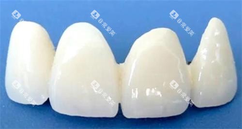 国产美晶瓷全瓷牙