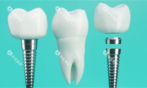 种植体产品卡通图 种植体产品卡通图