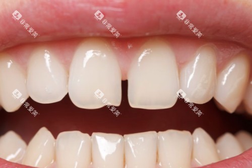 门牙牙缝大模型图