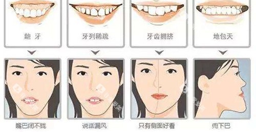 牙齿矫正脸型变化适应症