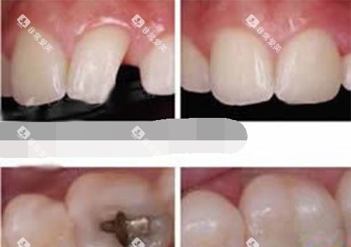 补牙过程 补牙过程