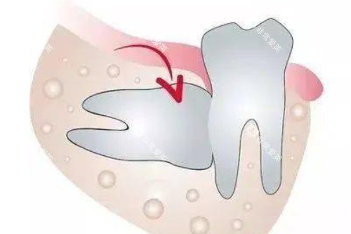阻生智齿卡通图 阻生智齿卡通图