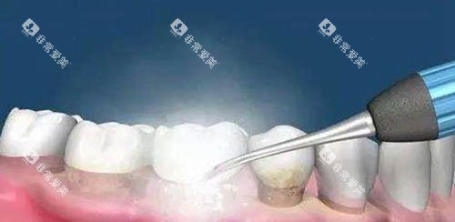 洗牙卡通示意图