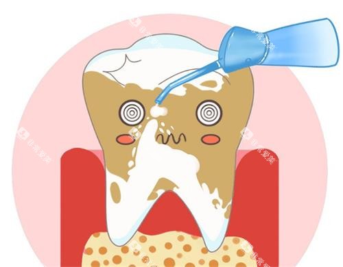 洗牙的动漫示意图
