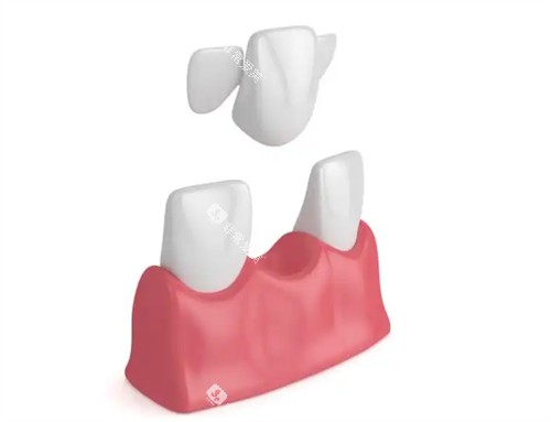 马里兰桥安装 马里兰桥安装