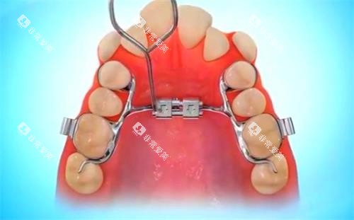 扩弓示意图 扩弓示意图