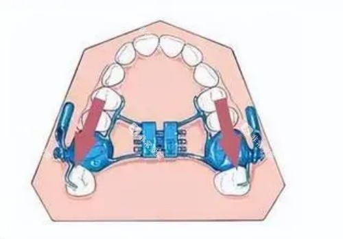 扩弓矫正示意图 扩弓矫正示意图