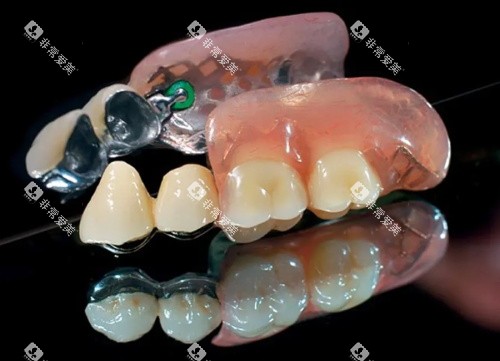 无挂钩假牙半口展示图