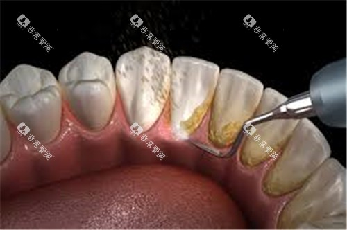 超声波洗牙 超声波洗牙