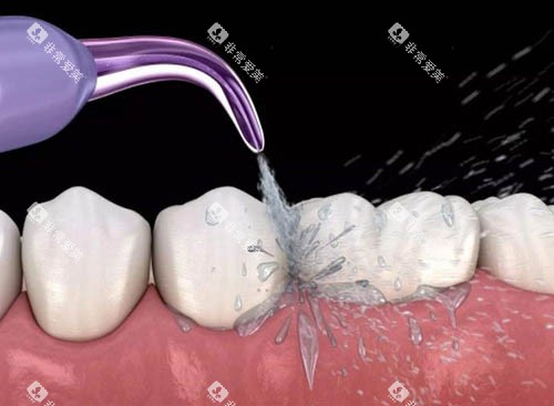 洗牙动画图 洗牙动画图
