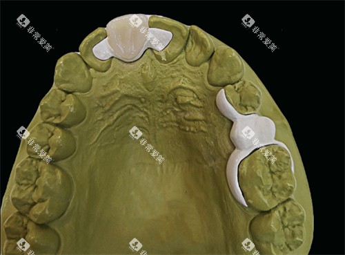 马里兰桥修复模型