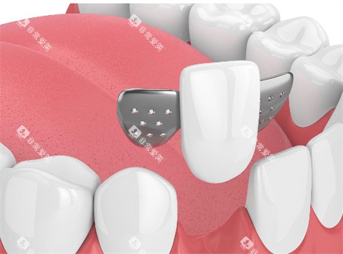 马里兰桥适合人群