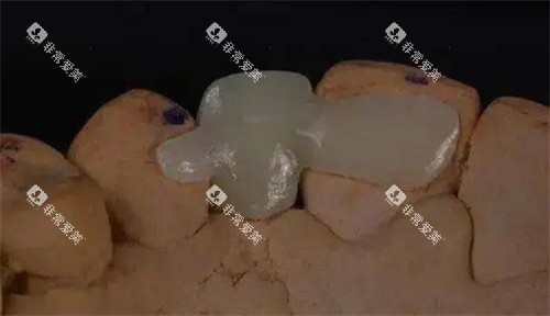 马里兰桥模型 马里兰桥模型