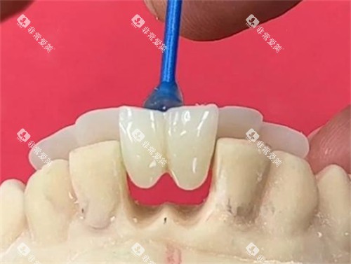 马里兰桥修复原理 马里兰桥修复原理