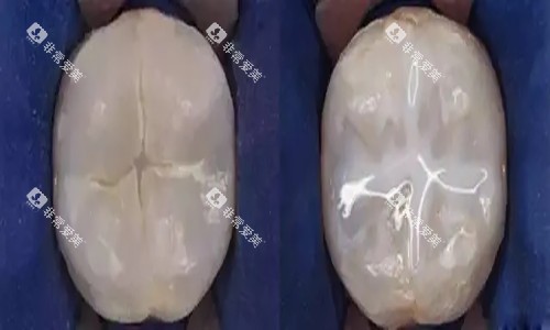 牙齿窝沟封闭卡通示意图