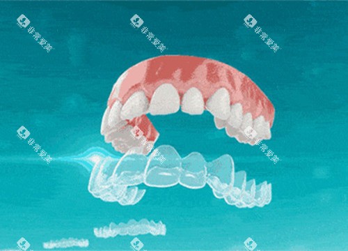 隐形矫正卡通示意图