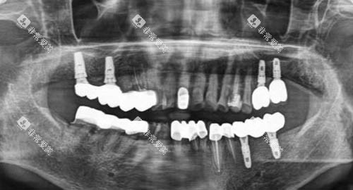 多颗牙齿种植ct 多颗牙齿种植ct