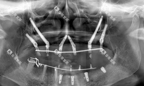穿颧穿翼种植ct照片 穿颧穿翼种植ct照片