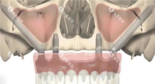 穿颧穿翼种植正面图 穿颧穿翼种植正面图