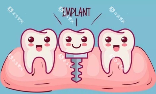 种植体动画展示图 种植体动画展示图