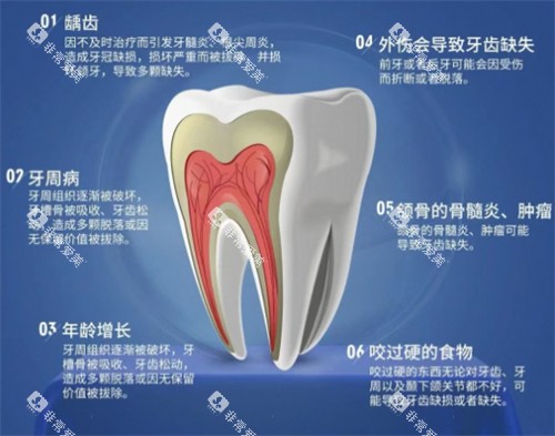 牙齿缺失原因